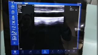 Wireless Linear Ultrasound Scanner for Precision Guidance